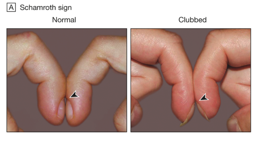 Nail Signs Clubbing 杵状指