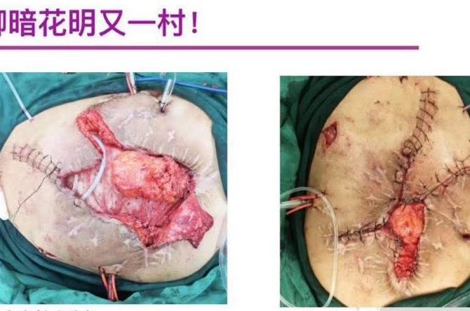 中成药膏对腹腔开放创面肠管保护作用的临床应用 – 王峰 医生