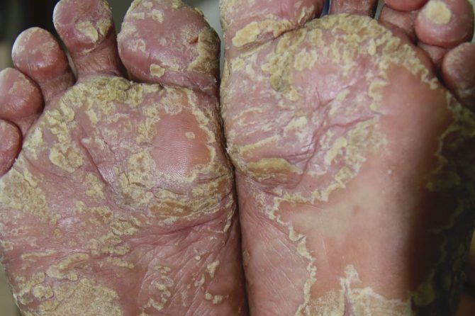 A 60-Year-Old Man with Severe Hyperkeratotic Palmoplantar Eczema 掌跖角化过度型湿疹