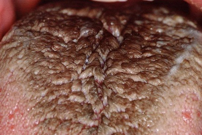 Hairy Tongue 黑毛(黑苔)舌