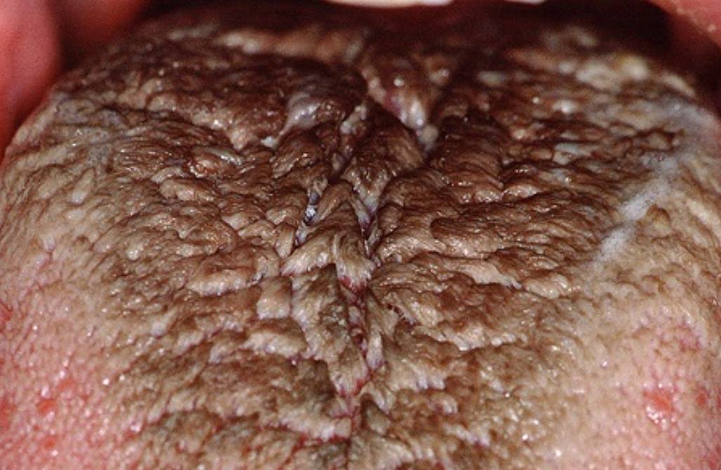 Hairy Tongue 黑毛(黑苔)舌