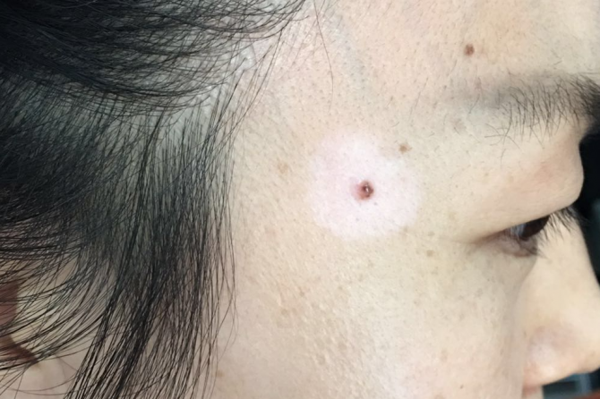 Halo nevus also known as Leukoderma acquisitum centrifugum, Sutton’s nevus, Perinevoid vitiligo 晕痣