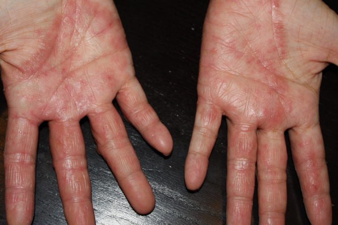 Hand Eczema 手湿疹