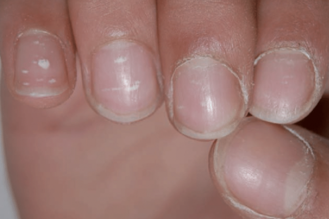 Nail Signs due to abnormal nail matrix function – ture leukonychia 真性白甲