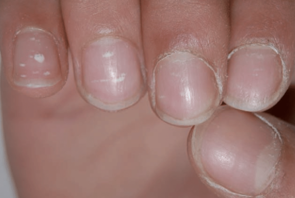 Nail Signs due to abnormal nail matrix function – ture leukonychia 真性白甲