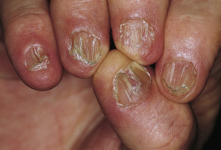 Nail Signs lichen planus 扁平苔藓指甲