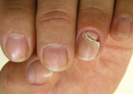 Nail Signs due to abnormal nail matrix function – Nail shedding 脱甲病