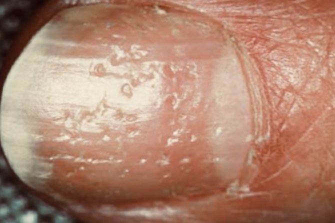 Nail Signs due to abnormal nail matrix function -Nail Pitting 指甲凹痕/凹洞