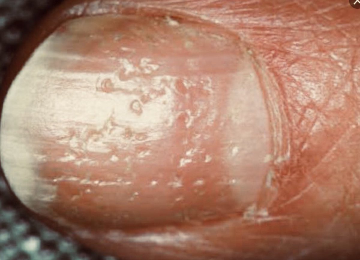 Nail Signs due to abnormal nail matrix function -Nail Pitting 指甲凹痕/凹洞