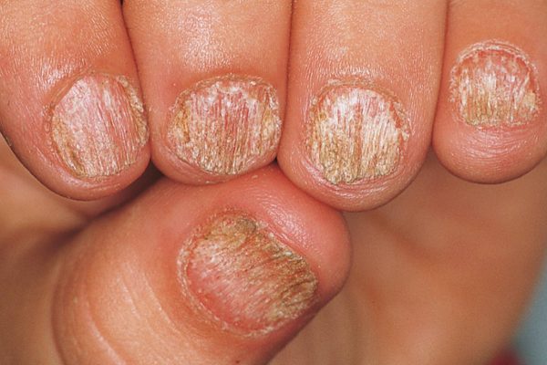 Nail Signs due to abnormal nail matrix function – sandpapered nails 粗面甲
