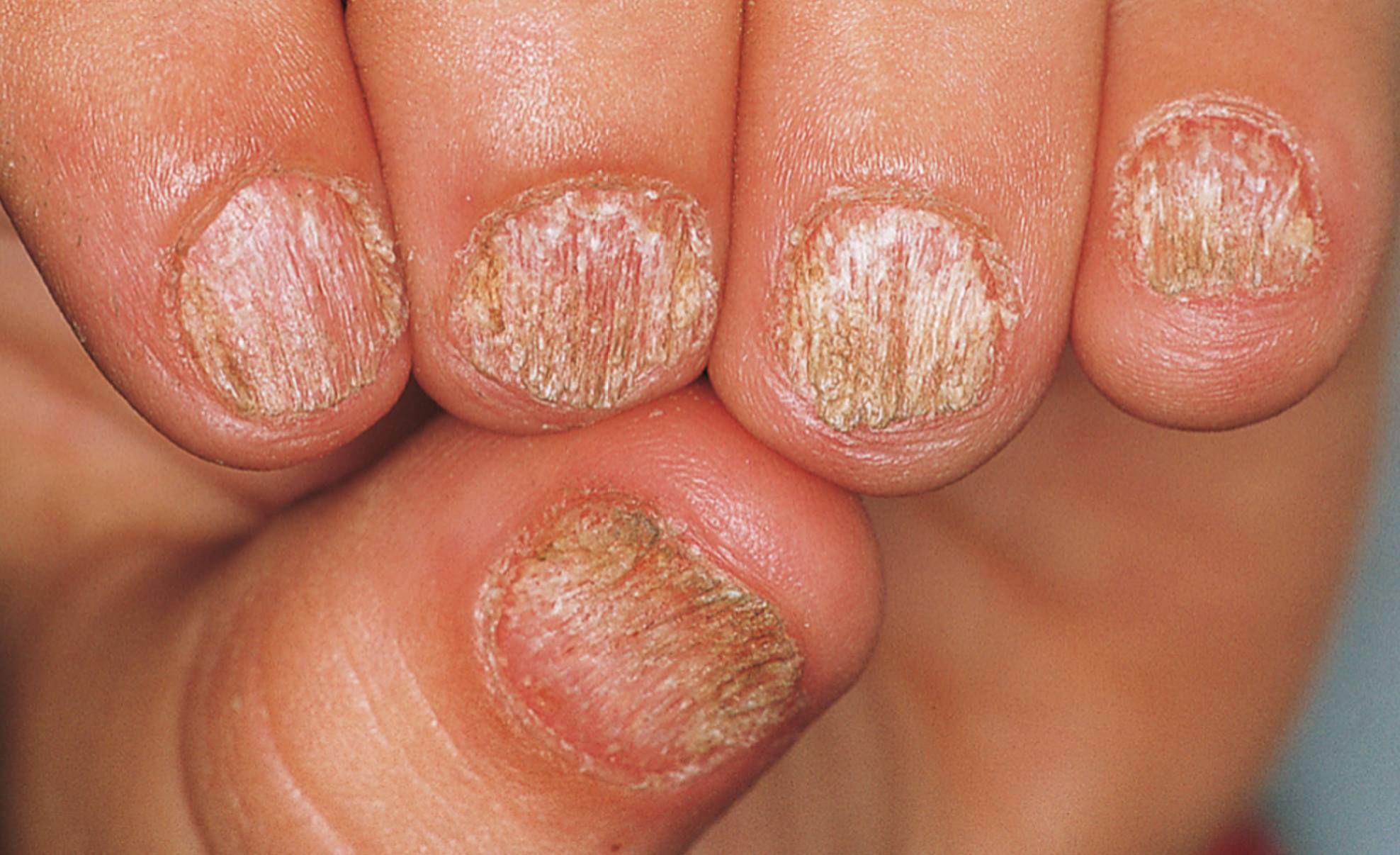 Nail Signs due to abnormal nail matrix function – sandpapered nails 粗面甲