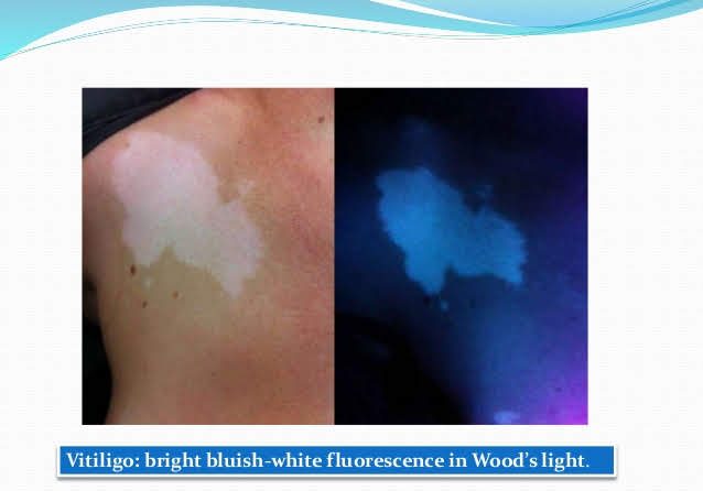 The Wood’s lamp can be used to confirm diagnosis when vitiligo is suspected. 白癜风的诊断