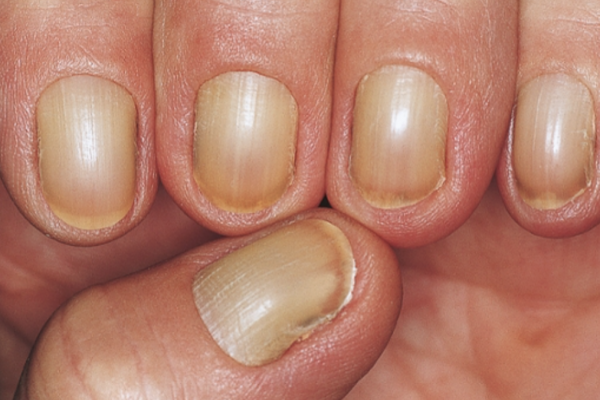 Nail Signs Yellow Nail Syndrome