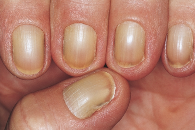 Nail Signs Yellow Nail Syndrome