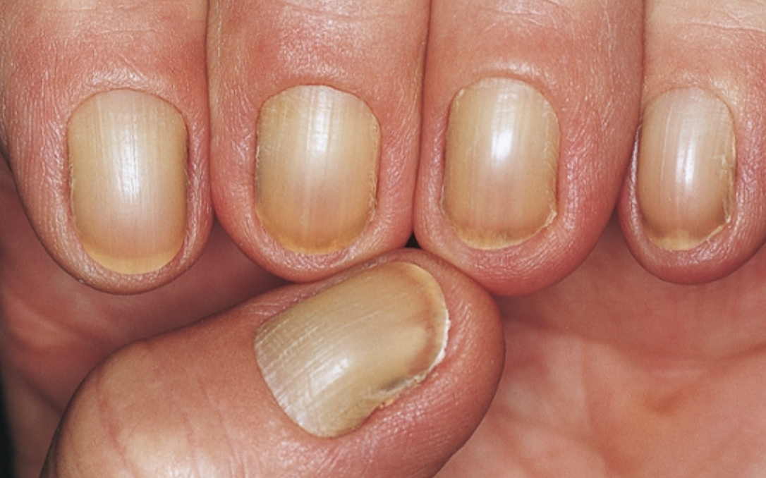 Nail Signs Yellow Nail Syndrome