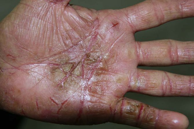 Occupational Associcated Hand Eczema 职业性手湿疹