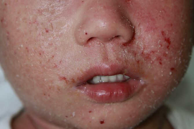 Severe Eczema in a 20-month-old Child 严重幼儿湿疹
