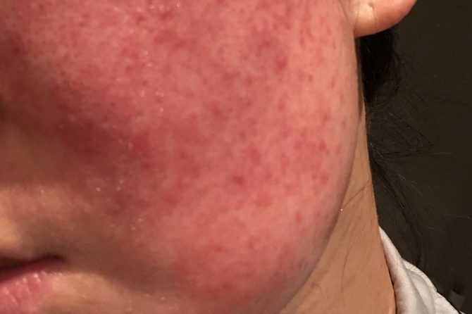 Cosmetics Induced Dermatitis due to Facial Mask 甘草酸苷美白面膜导致的皮炎