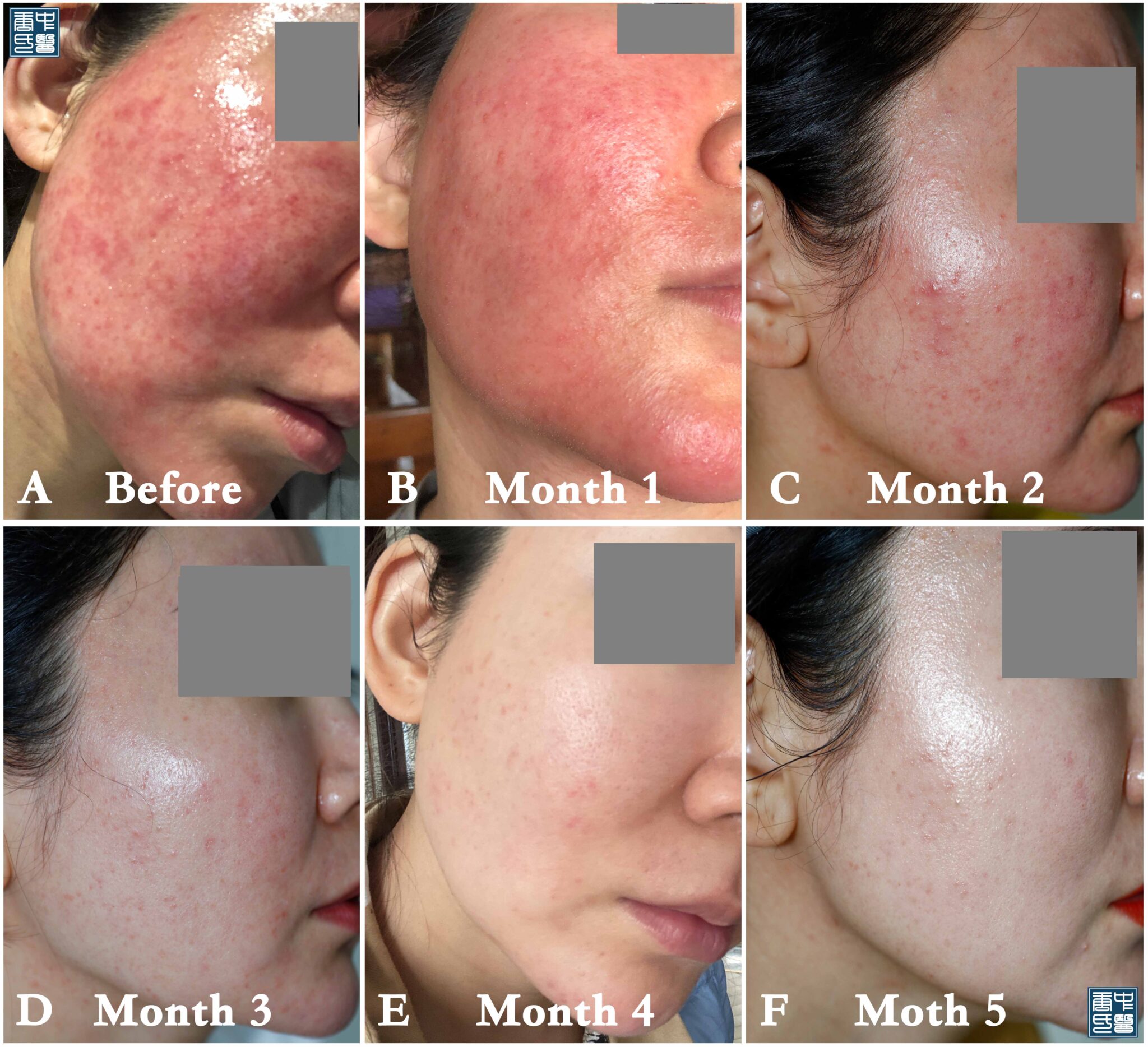 licorice dermatitis A3