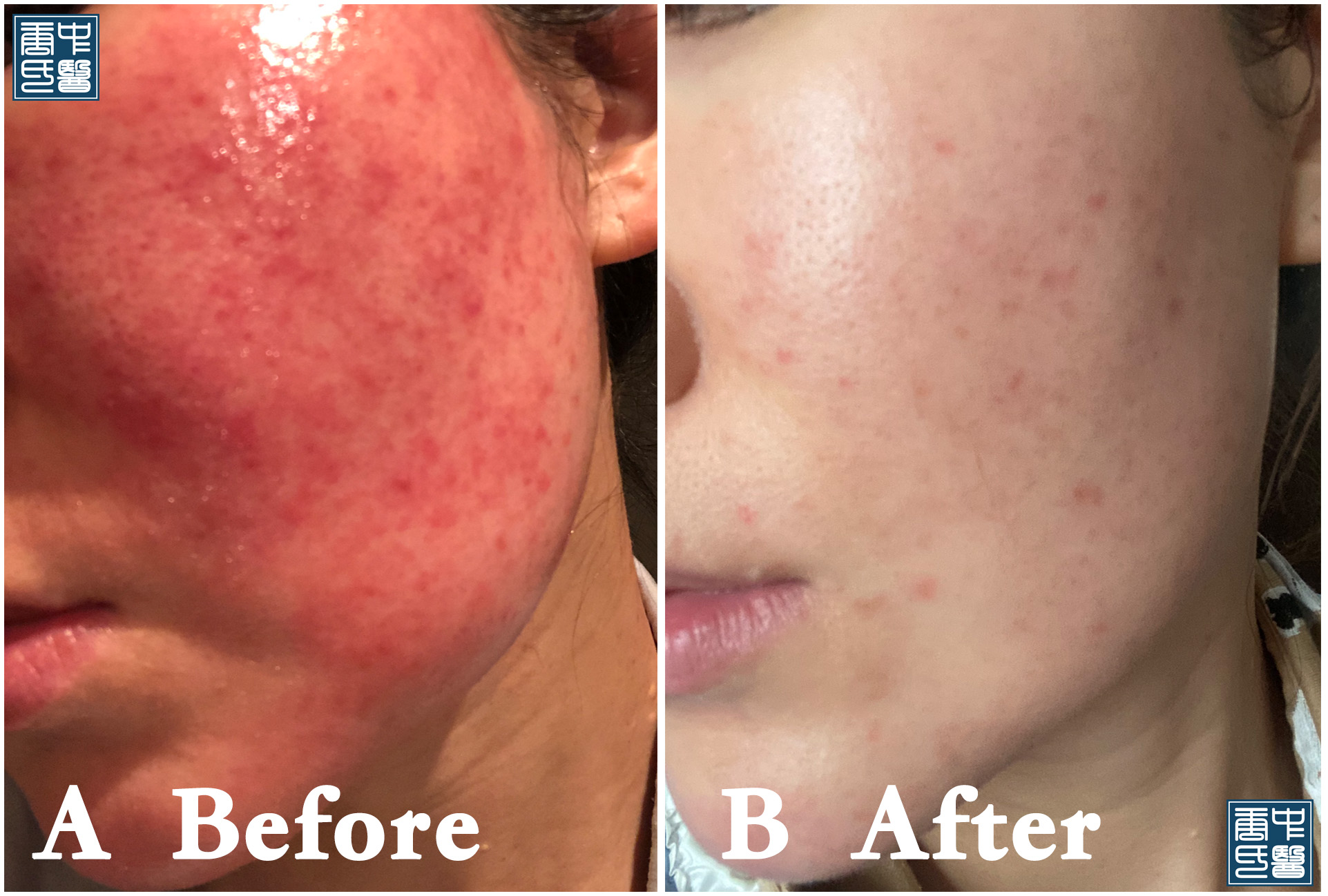 licorice dermatitis B5