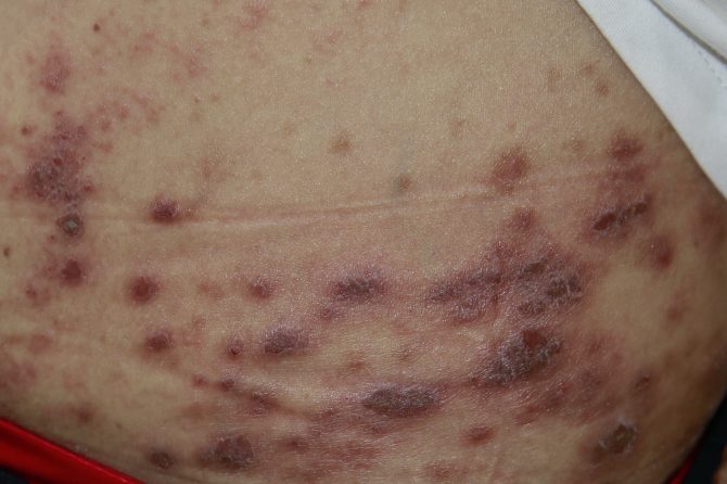 Prurigo Simplex trigged by hair dyes 染发剂激发的单纯痒疹