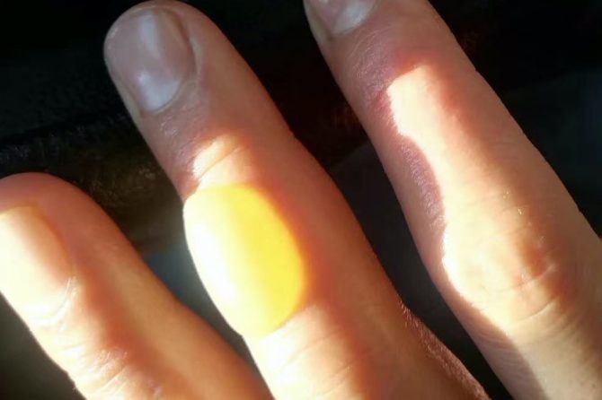 2nd-degree burns healed in 12 days, no scar left 二度烧伤12天治愈不留疤痕