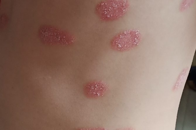 Psoriasis in Children 儿童银屑病