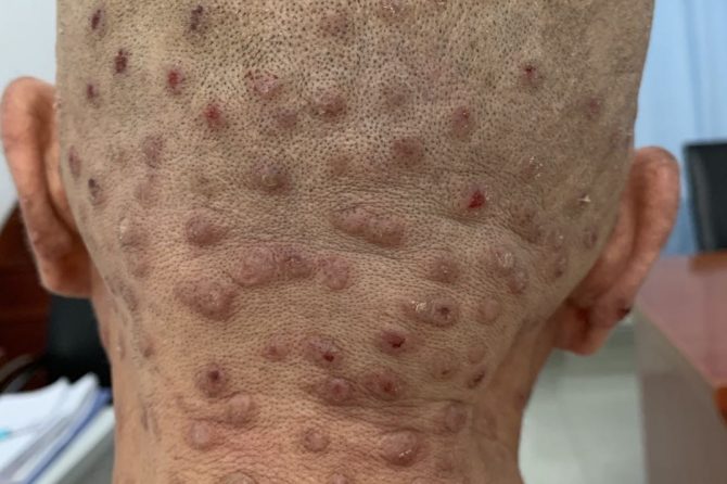 A 64-year-old man with 15-year history of Prurigo Nodularis 64岁罹患结节性痒疹15年