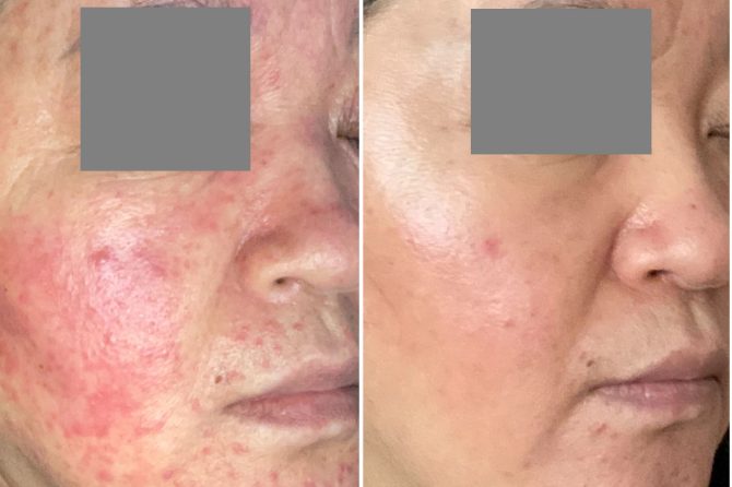 Steroids Rosacea Overlaps Retinoid Dermatitis 激素性皮炎叠加维A酸皮炎