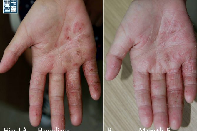 Do we have eczema gene(s) – Time to rethink biologics Dupilumab (Dupixent)  关于湿疹基因—生物药的再思考