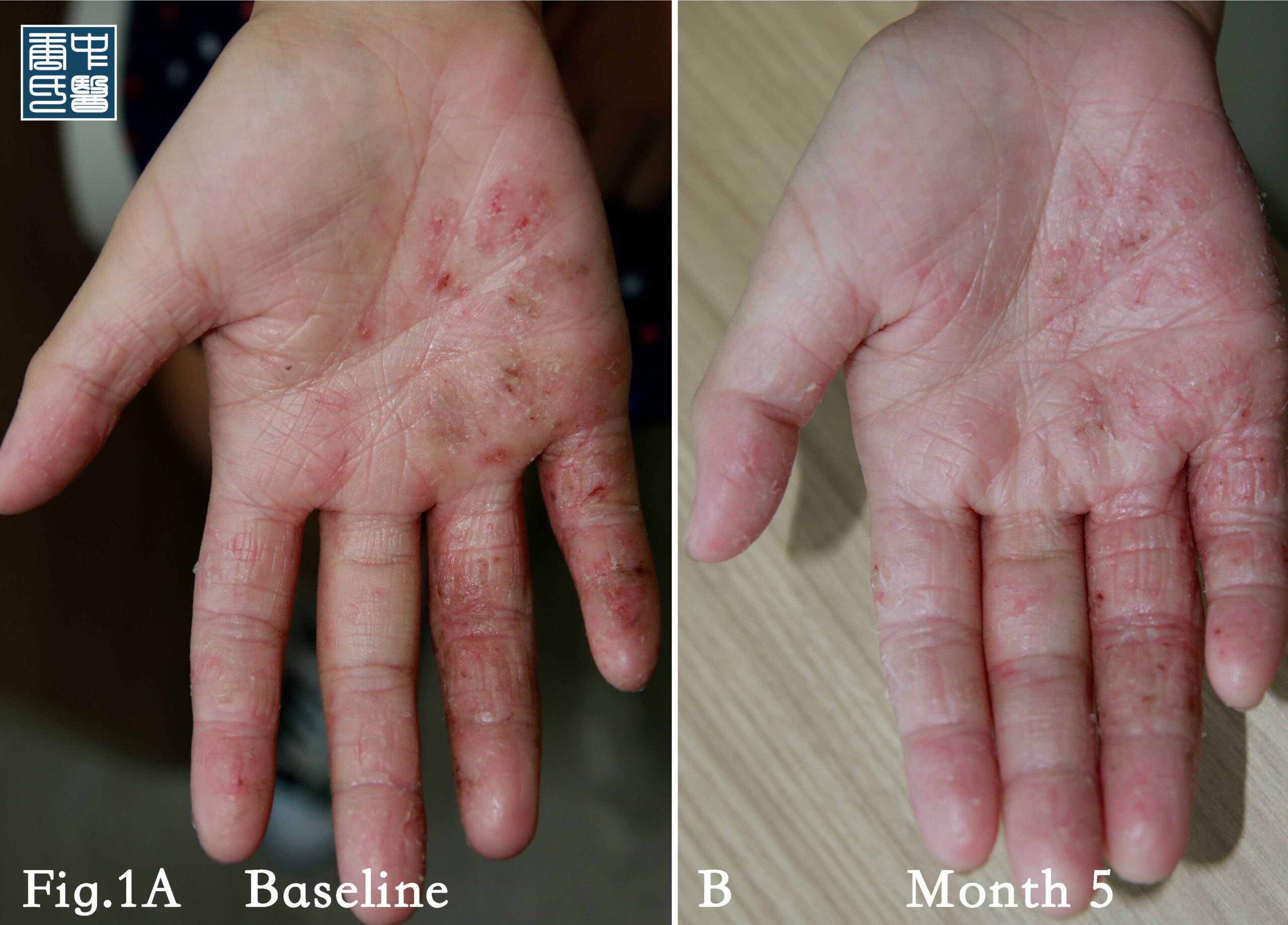 Do we have eczema gene(s) – Time to rethink biologics Dupilumab (Dupixent)  关于湿疹基因—生物药的再思考
