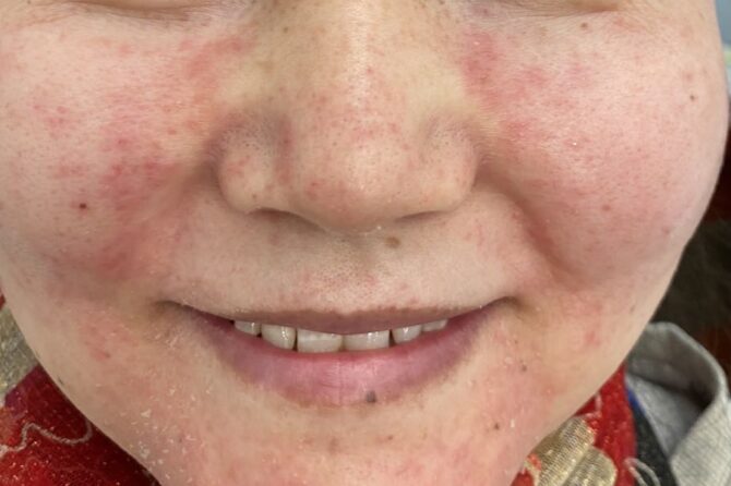 A Topical Steroid Induced Rosacea 外用类固醇诱导出现酒糟性皮炎