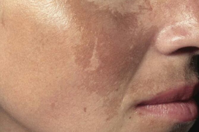 Midnight Feasts Could Cause Melasma 夜宵也会导致黄褐斑