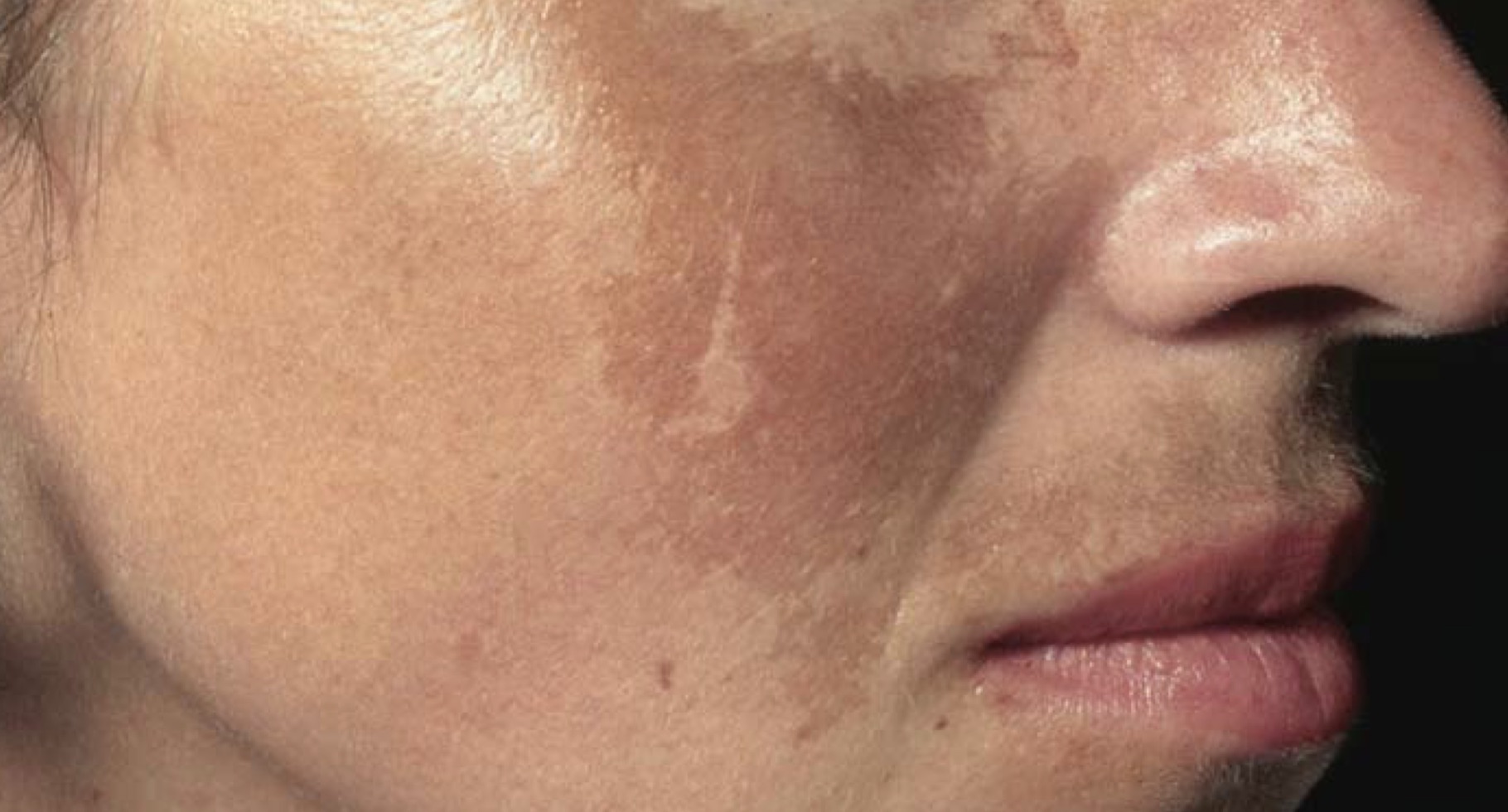 Midnight Feasts Could Cause Melasma 夜宵也会导致黄褐斑