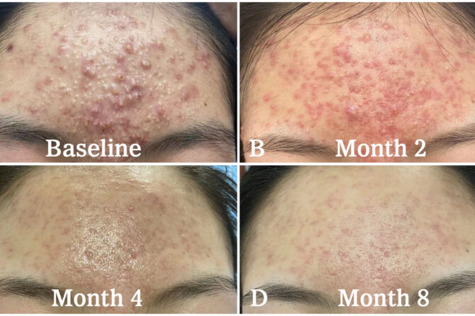 What is Acne-like Breakouts? 痤疮样痘痘到底是什么？