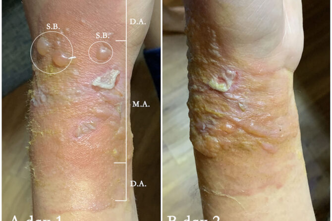 Second degree burn healed in 10 days with herbal formulated HLQ ointment