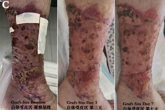 Postoperative Skin Autograft Wound Care 烧伤植皮术后伤口治疗