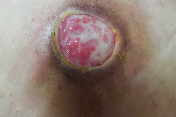 Stage-3 Pressure Ulcers 褥疮