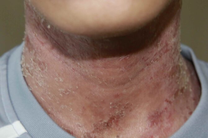 A 15-year-old boy with  10-year eczema, 15岁少年10年湿疹