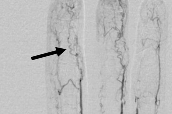 Thromboangiitis obliterans (Buerger’s disease)  血栓闭塞性脉管炎(伯格病)