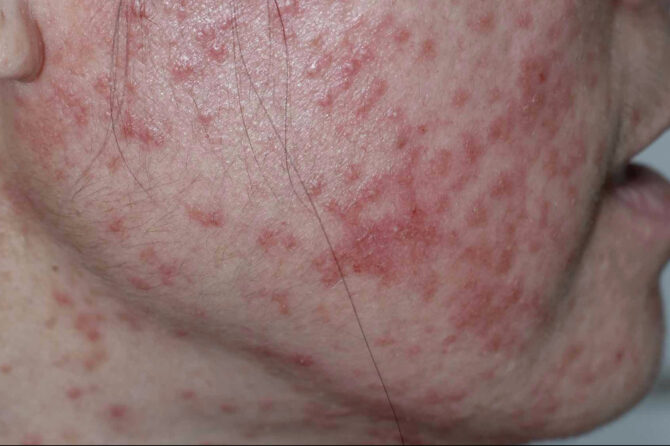 Retinoid Dermatitis 维A酸皮炎