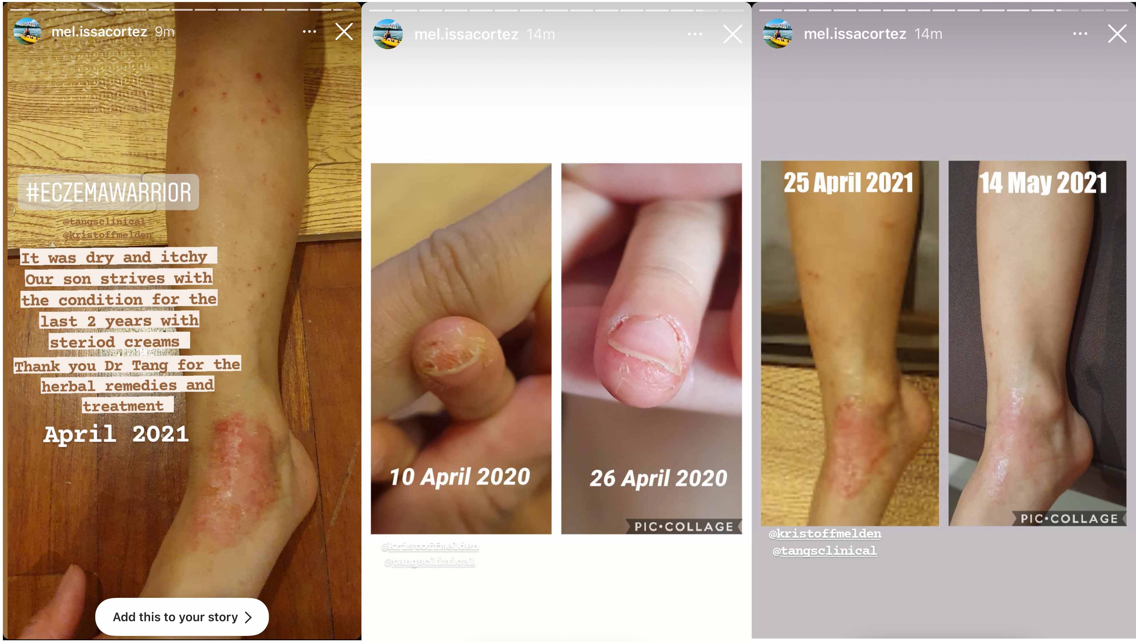 tesimonial eczema 5