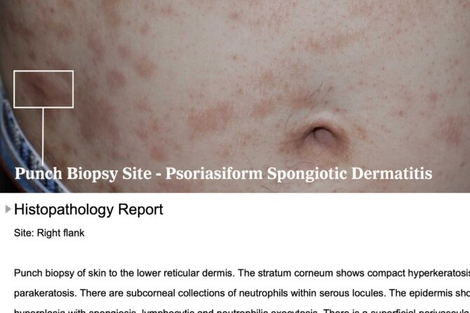 Psoriasiform Spongiotic Dermatitis 银屑病样海绵状皮炎
