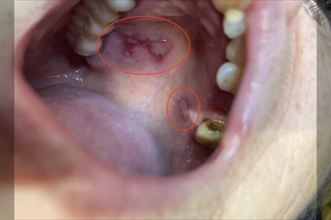 A suspected Mucous Membrane Pemphigoid MMP case 口腔黏膜类天疱疮
