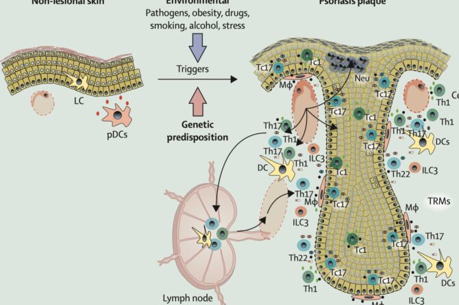 Psoriasis Pathogenesis Review 银屑病发病机理的新进展和回顾