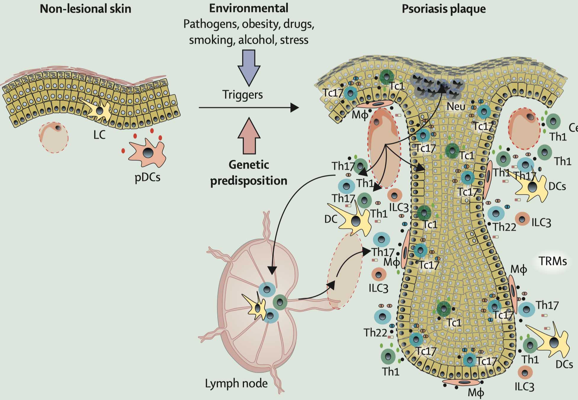 Psoriasis Pathogenesis Review 银屑病发病机理的新进展和回顾