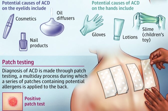 Allergic Contact Dermatitis 变应性接触性皮炎