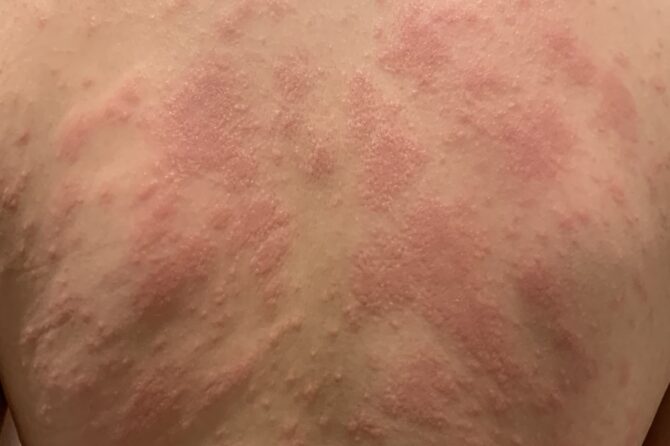 Pruritic Urticarial Papules 瘙痒性丘疹荨麻疹