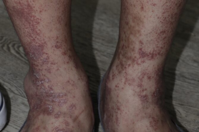 A 50-year-old man presented with cutaneous small vessel vasculitis CSVV 皮肤小血管炎