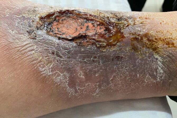 Leg Ulcer of Venous Insufficiency of Left Lower Extremity 左下肢静脉性溃疡